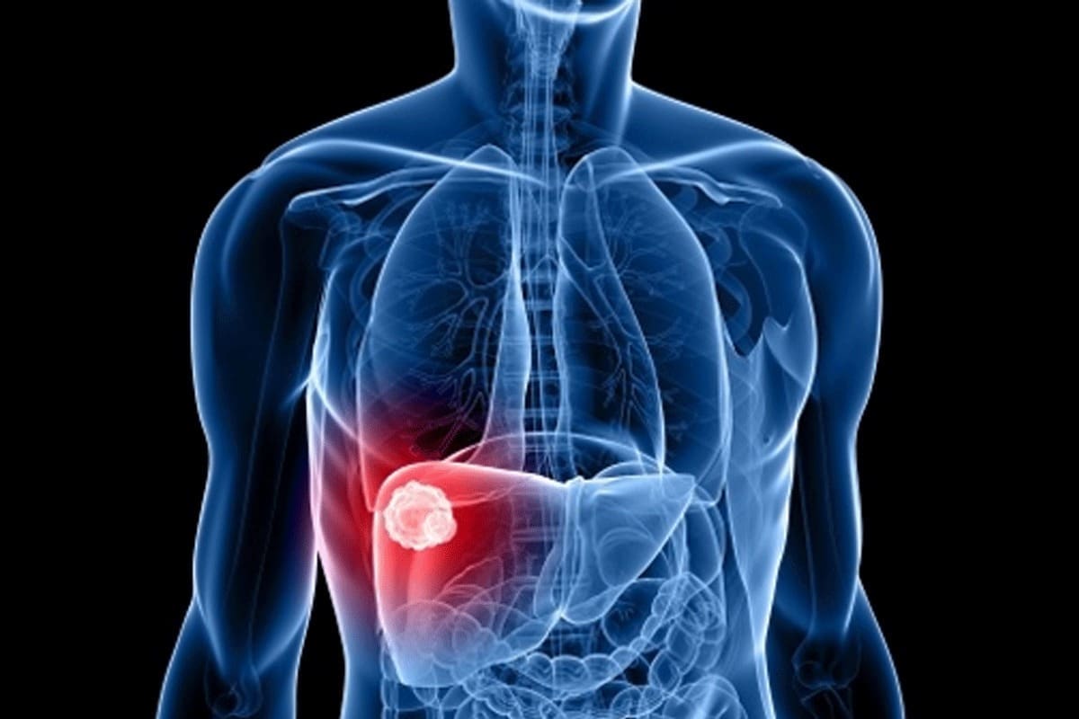 How Long Is Recovery Time for Liver Tumor Surgery When Doctor Removed Liver During Surgery