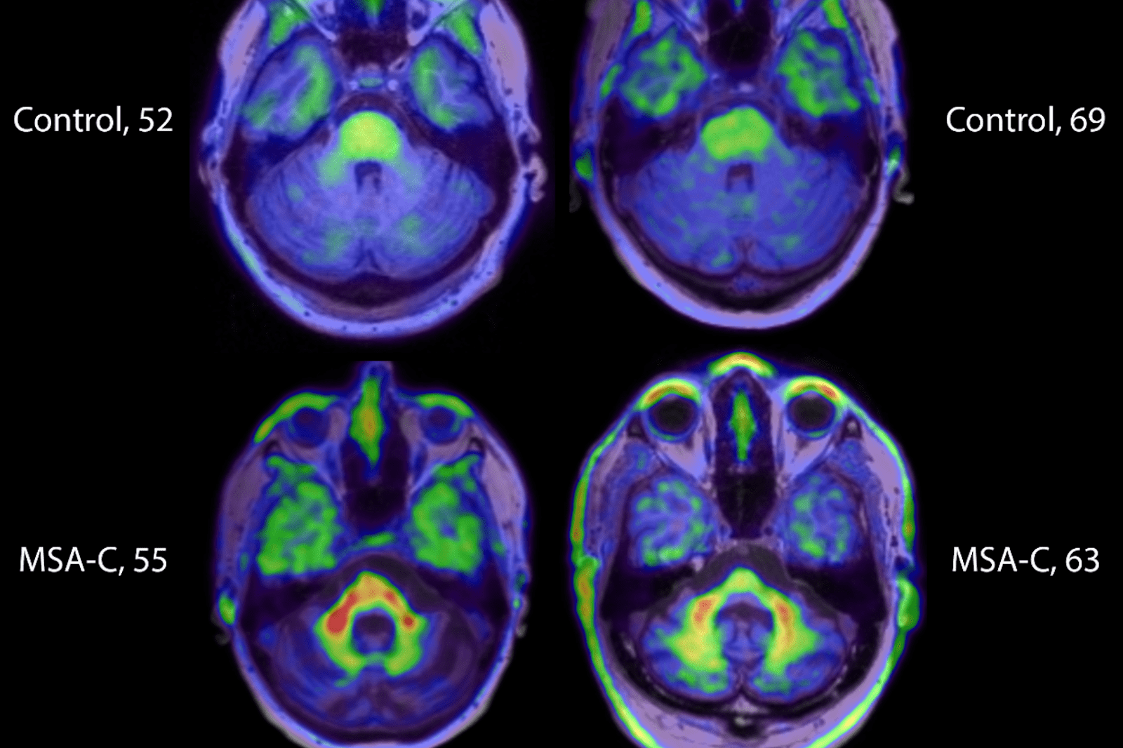 Brain Scan for Anxiety: Powerful Insights for Mental Health