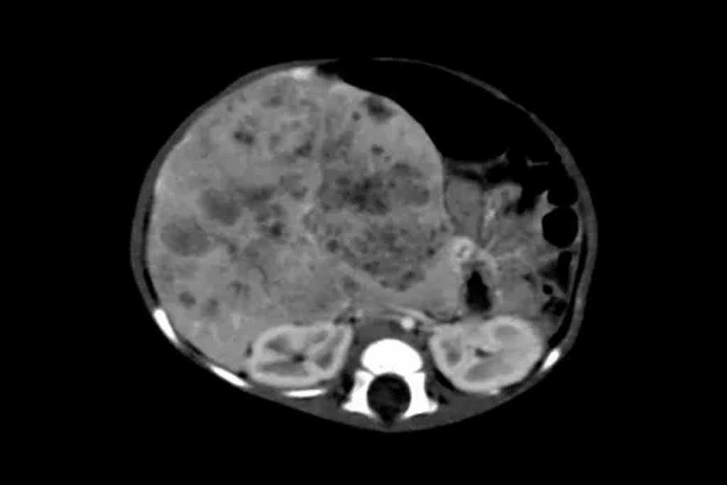 How Big Can Hepatoblastoma Tumors Get? Size and Insights