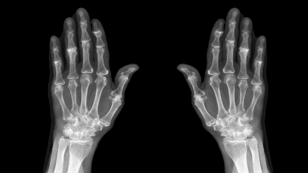 Osteoarthritis Scan: Powerful Tool for Joint Health Assessment