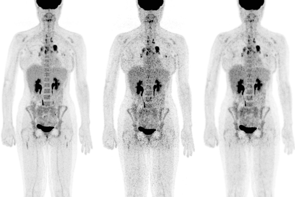 Is it serious if you need a PET scan? 2 Cancers Not Visible on PET Scans: Important Limitations