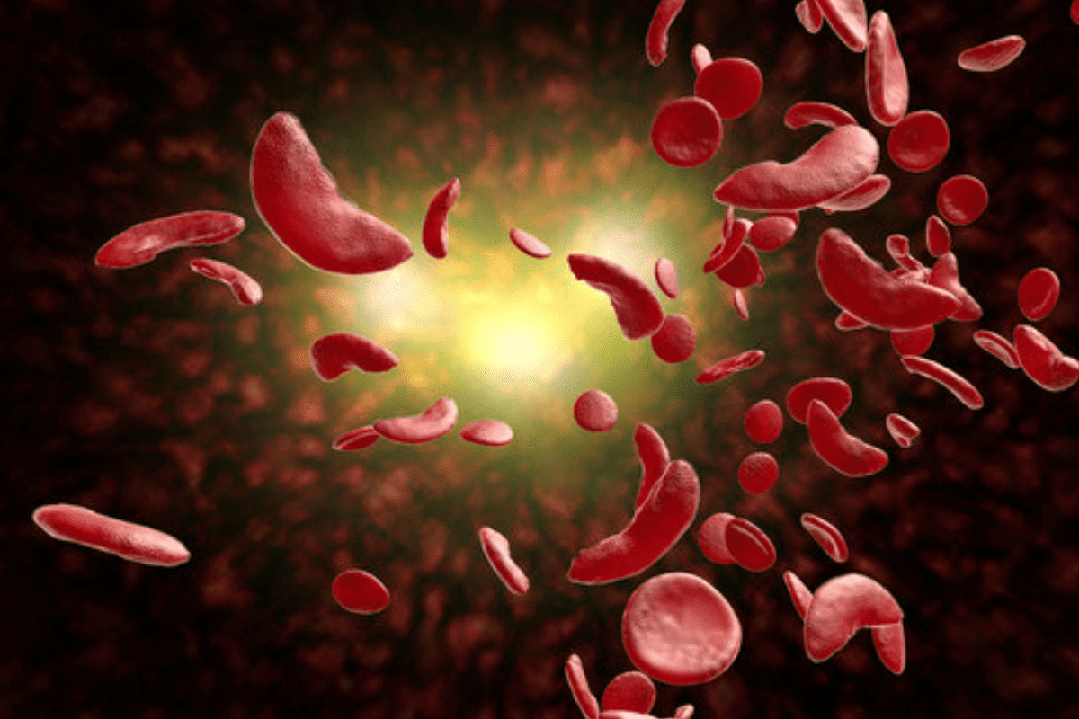 sickle cell anemia Treatment: What Age Is Gene Therapy Approved For?