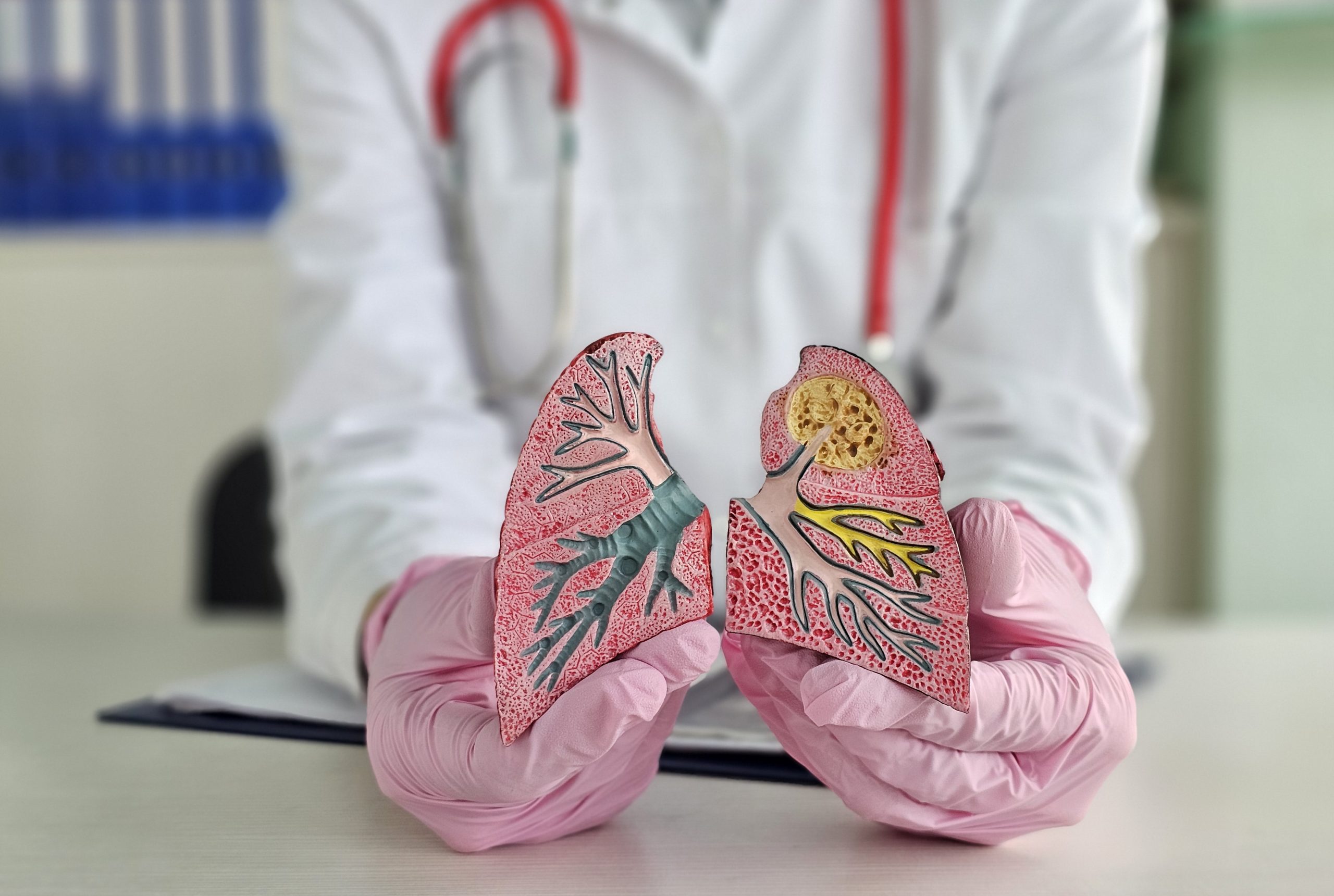 Where Do Most Lung Cancers Start