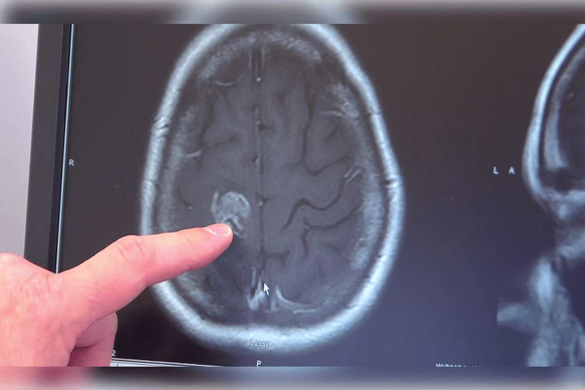 Why Can a CT Scan Miss a Brain Tumor? Understanding Detection Limits and Alternatives
