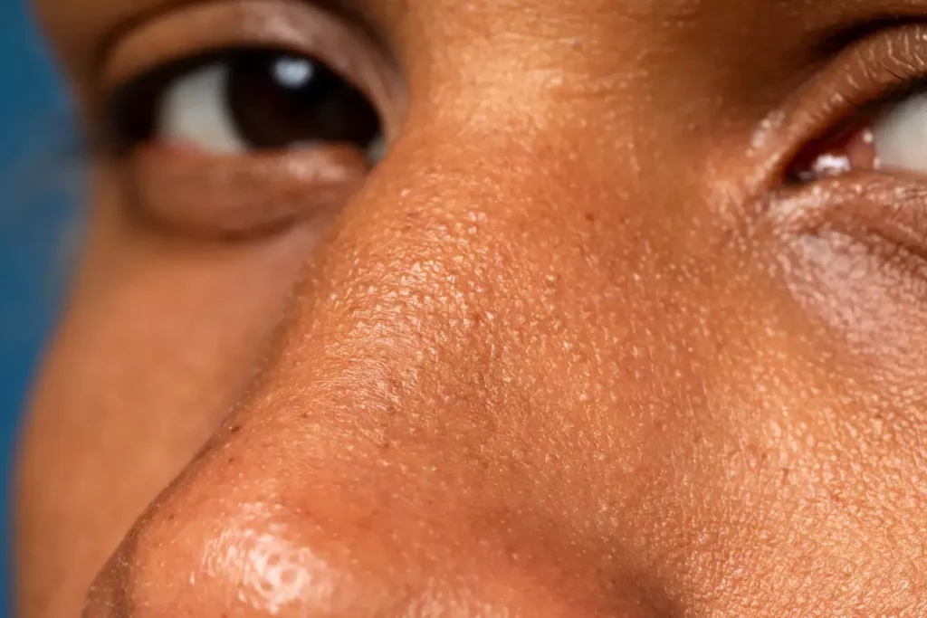 A close-up photograph of a person's face, clearly showing the textured, pinkish-red lesion on the skin characteristic of basal cell carcinoma. The lighting is soft and even, illuminating the details of the affected area. The background is blurred, keeping the focus on the skin condition. The angle is slightly angled to provide a detailed, clinical view. The mood is one of medical examination, with a sense of concern but also professional objectivity. The image conveys the need for careful diagnosis and treatment of this common form of skin cancer.