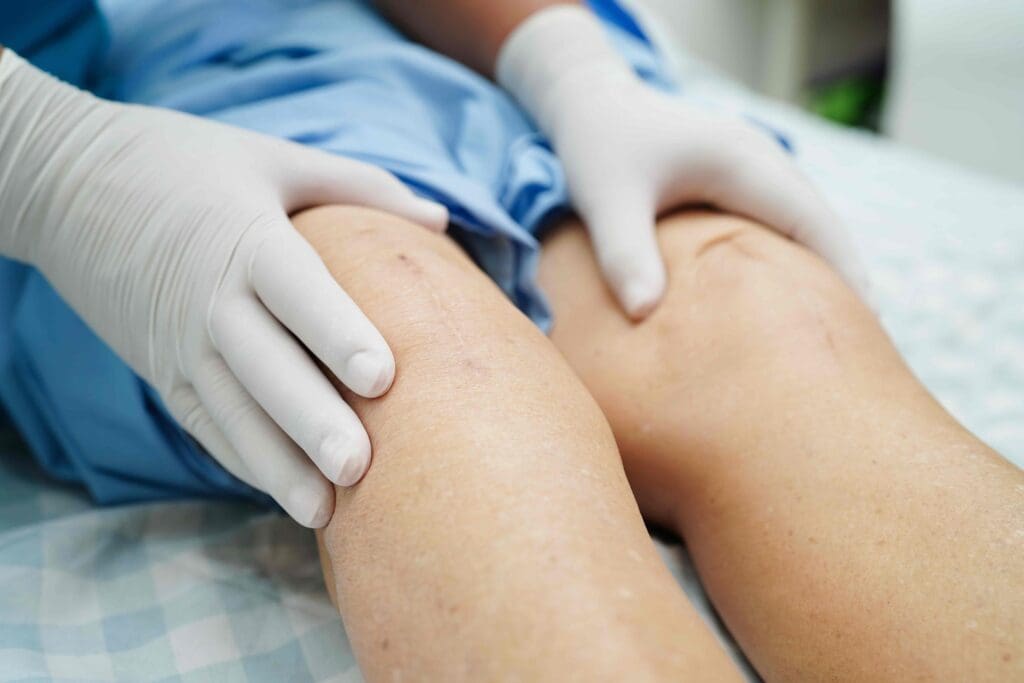 A close-up view of a partially healed surgical scar on the knee