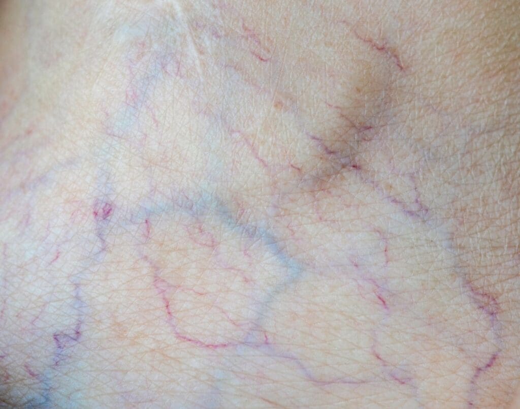 A close-up view of an arteriovenous malformation (AVM) on the skin