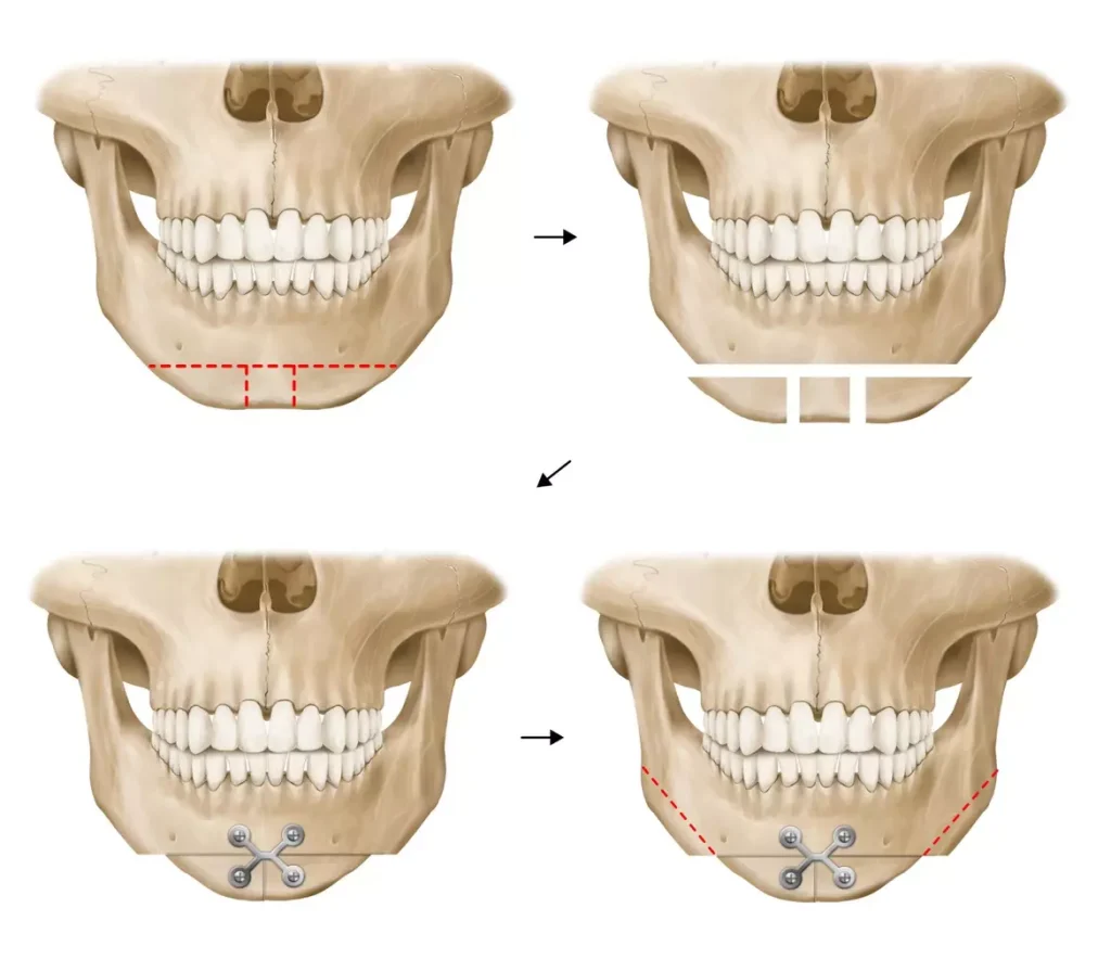 A cross-section of a human jaw, revealing the intricate structure of dental bone. In the foreground, a highly detailed, anatomically accurate depiction of the spongy, trabecular bone, showcasing its intricate network of interconnected struts and pores. The middle ground features the compact, dense cortical bone lining the exterior, capturing its smooth, laminated appearance. The background subtly highlights the surrounding soft tissues, gently blurred to emphasize the focal point of the bone graft origin. The scene is illuminated by a warm, directional light, casting subtle shadows that accentuate the three-dimensional forms. The overall mood is one of scientific precision and medical significance, reflecting the critical role of bone grafts in successful dental implant procedures.