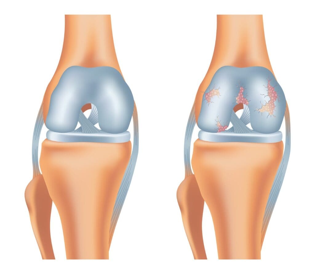 A cross-sectional illustration showcasing the intricate anatomy of a partial knee arthroplasty.