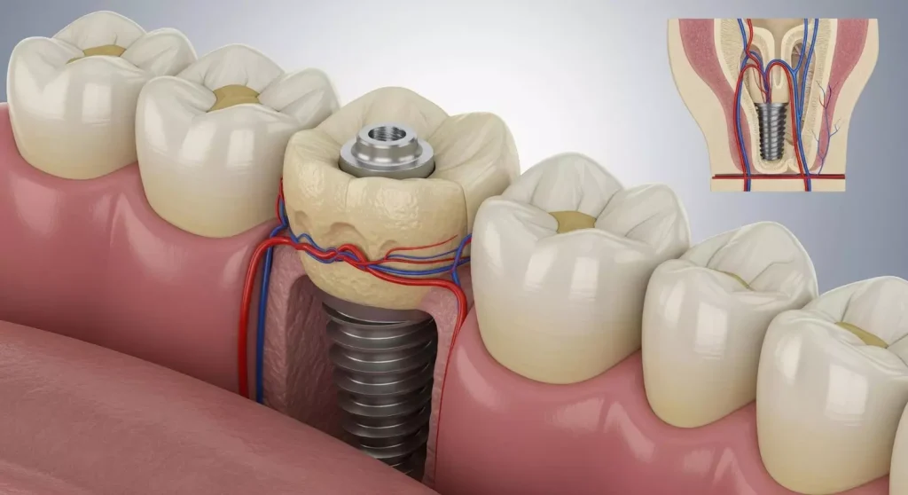 A cross-sectional view of dental bone grafts for implants, featuring a detailed examination of the graft material. The foreground showcases the grafted bone, its texture and composition visible under a high-magnification lens. The middle ground highlights the integration of the graft with the surrounding natural bone, creating a seamless transition. The background depicts the overall dental structure, providing context for the grafting procedure. Warm, natural lighting illuminates the scene, conveying a sense of medical precision and care. The image effectively communicates the technical details and process of dental bone grafting for implants.