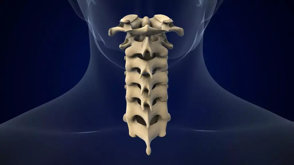 A detailed 3D anatomical illustration showcasing the key features of cervical spinal stenosis. Crisp, high-resolution rendering with a neutral color palette and clinical medical style. The scene depicts the cervical vertebrae and spinal cord, highlighting the narrowing of the spinal canal and compression of the nerve roots. Precise anatomical details like intervertebral discs, ligaments, and bone spurs are visible. Lighting is soft and directional, emphasizing the internal structures. The perspective is a clean side view, allowing clear visualization of the pathological changes. The overall mood is informative and educational, suitable for use in a medical article on cervical spinal fusion.