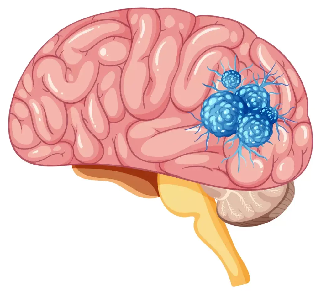 A detailed anatomical illustration of a human brain with a visible brain tumor in the cerebellum region. The tumor appears as a distinct, bulbous growth protruding from the brain structure. Surrounding the brain, depict the vestibular system responsible for balance and equilibrium, highlighted to show the connection between the tumor and balance issues. Use a muted, clinical color palette with soft lighting from the side, creating a sense of depth and dimensionality. Render the image in a clean, technical style reminiscent of medical textbook illustrations, conveying a sense of educational purpose.