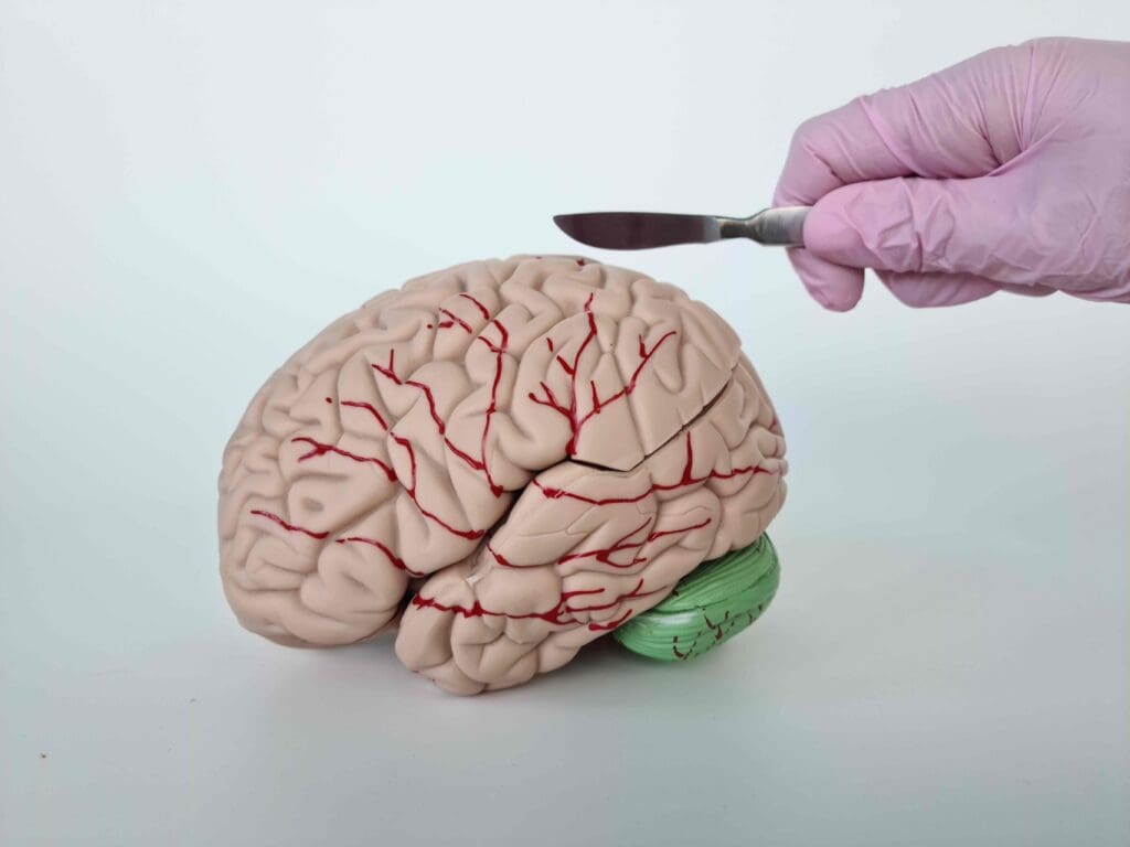 A detailed brain cross-section reveals the prevalence of venous malformation