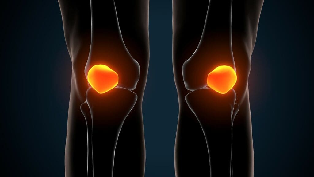 A detailed, close-up view of a human knee joint, revealing the localized damage caused by osteoarthritis