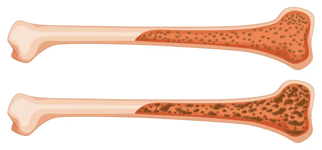 A detailed comparison of yellow and red bone marrow types, presented as an anatomical illustration. The foreground showcases the key structural and functional differences, with yellow marrow shown as a dense, fatty tissue and red marrow as a spongy, vascular structure. The middle ground highlights the bone anatomy, including the cortical and trabecular regions. In the background, a muted color palette and soft lighting create a serene, educational atmosphere, emphasizing the scientific nature of the subject. Rendered with a photorealistic style, high depth of field, and precise attention to anatomical accuracy to best illustrate the "Basics of Bone Marrow".