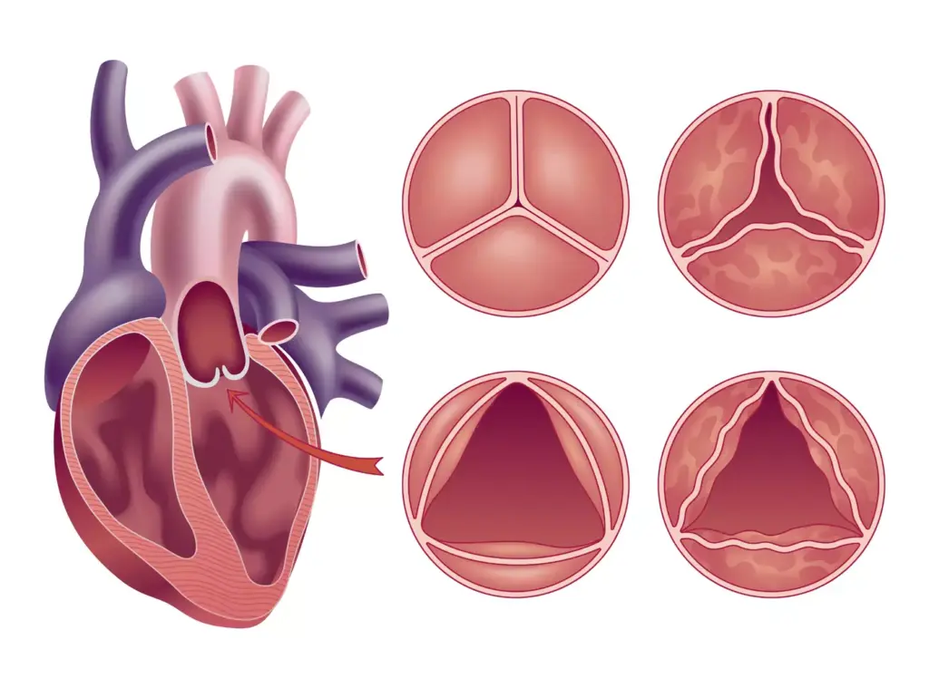 A detailed cross-section of a human heart valve, rendered in a realistic, high-quality medical illustration style. The main focus is on the delicate valve mechanism, with its intricate leaflets and supporting structures clearly visible. The valve is depicted in a neutral, neutral-toned background that emphasizes the medical and anatomical nature of the subject. Subtle lighting from the side casts soft shadows, enhancing the depth and three-dimensionality of the valve. The image should convey a sense of scientific precision and technical understanding, suitable for use in a medical article on heart valve replacement procedures.