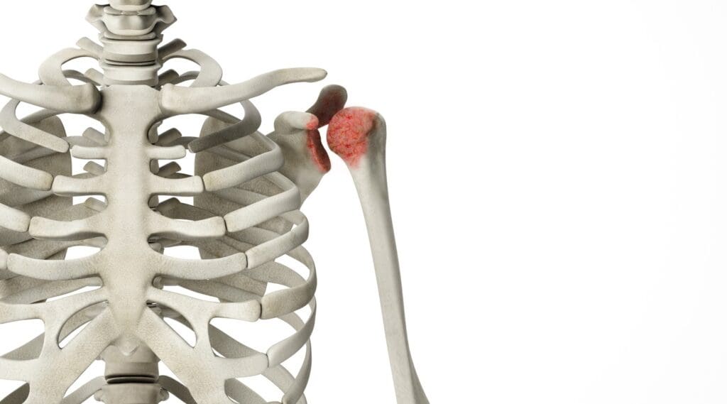 A detailed cross-section of bone metastasis A detailed cross-section of bone metastasis
