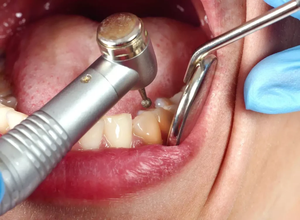 A detailed cross-section view of dental bone grafting procedure. In the foreground, a partially exposed human jawbone with a missing tooth socket. The middle ground depicts the surgical placement of a bone graft material, such as demineralized bovine bone, into the socket to stimulate new bone growth. In the background, a microscopic view of the bone graft particles integrating with the patient's natural bone structure. Realistic textures, muted lighting, and a clinical, scientific atmosphere convey the technical nature of this medical procedure.