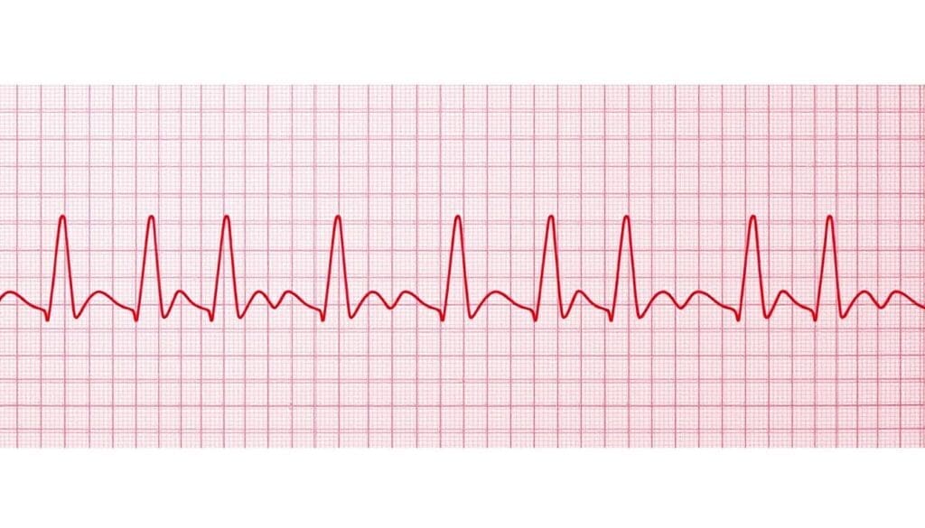 A detailed electrocardiogram (ECG) displaying the characteristic pattern of atrial flutter, a type of abnormal heart rhythm. The ECG shows a rapid, regular series of oscillating waves, indicating the rapid, uncoordinated contraction of the atria. The image should be presented against a clean, clinical backdrop, with a neutral color palette to emphasize the medical nature of the subject. Lighting should be bright and even, with a slight angle to create depth and highlight the intricate details of the ECG waveform. The overall composition should be balanced and centered, allowing the viewer to clearly observe and analyze the diagnostic features of the ECG.