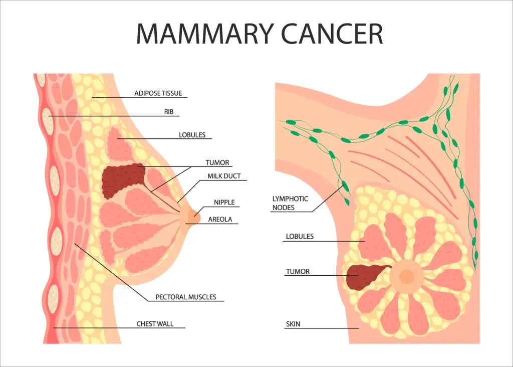 A detailed, high-resolution medical illustration of multiple benign breast tumors, depicted in a cross-sectional view. The tumors appear as distinct, well-defined masses within the breast tissue, with a smooth, round or oval shape and a uniform, soft texture. Shades of pink and off-white dominate the color palette, with subtle variations in tone to differentiate the different tumor structures. The image is rendered with a clean, clinical aesthetic, using soft, diffuse lighting to highlight the internal architecture of the tumors. The composition emphasizes the tumors' location and size relative to the surrounding breast tissue, providing a clear visual representation of a "benign breast tumor" for the article's educational purposes.