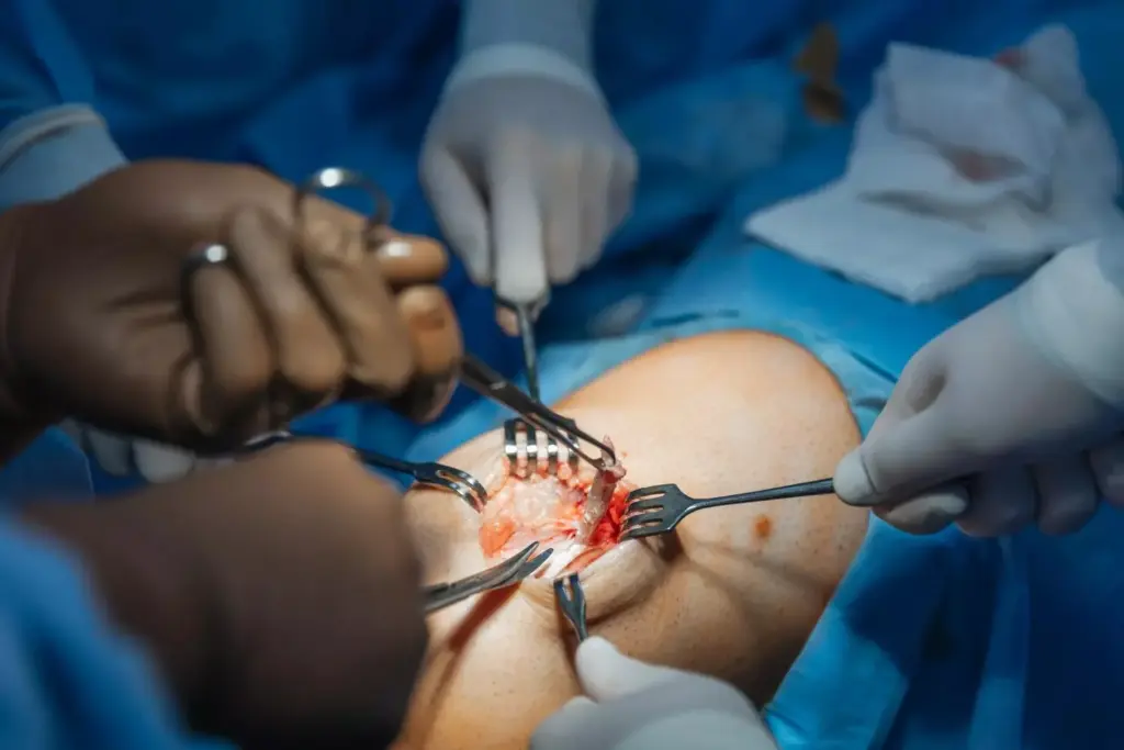 A detailed surgical scene depicting a revision knee replacement procedure. In the foreground, the surgeon's hands skillfully manipulate the joint, guided by the bright surgical lights overhead. The middle ground reveals the patient's exposed knee, the incision visible against the pale skin. In the background, surgical instruments and monitors provide a sense of the complex medical setting. The image conveys a sense of precision, focus, and the high-stakes nature of this specialized orthopedic procedure.