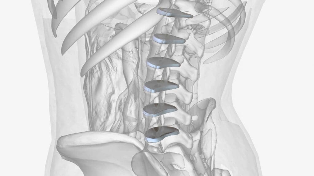 A high-resolution, photorealistic image of a spinal fusion surgery in progress