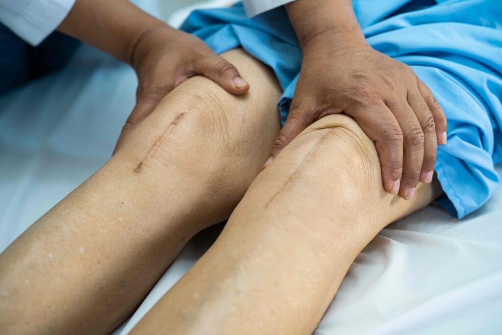 A swollen, reddish knee joint with prominent surgical scars