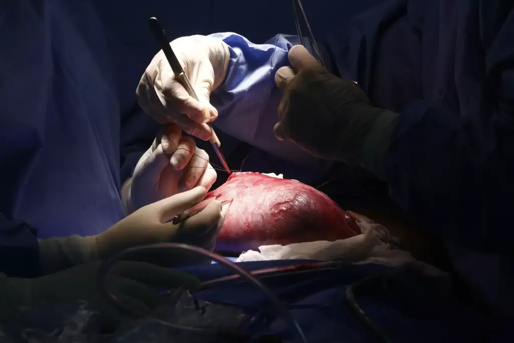 Abdominal Aortic Aneurysms and Surgical Options