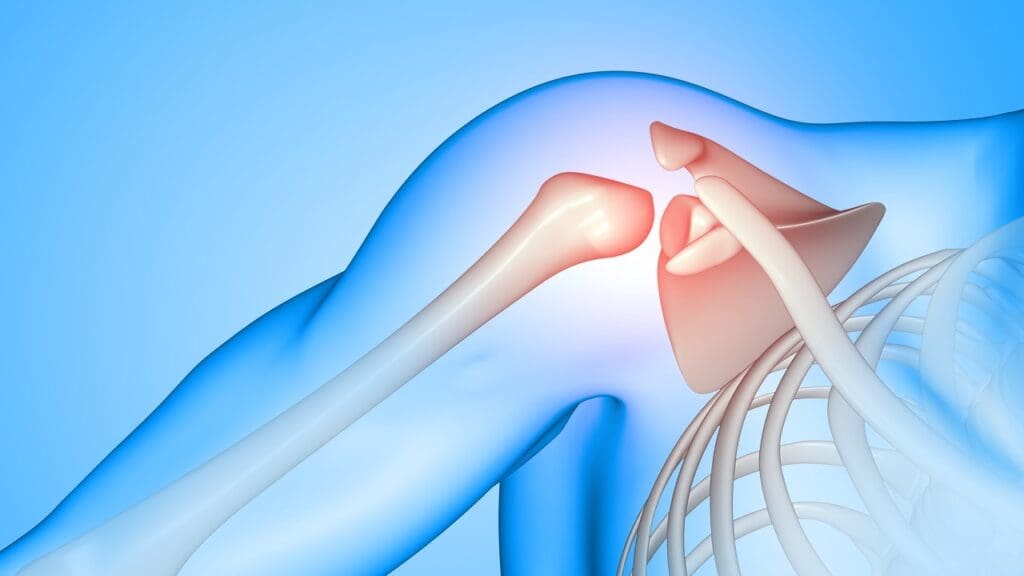 Arthroscopic Debridement Shoulder Surgery 