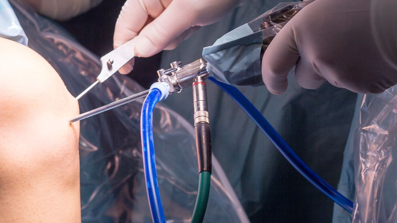 Arthroscopic Debridement Shoulder Surgery