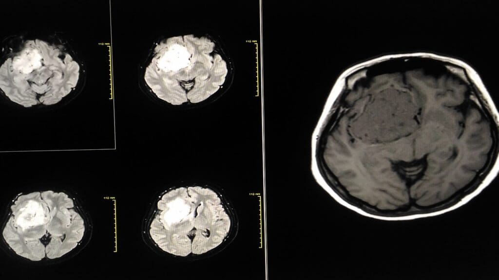 Brain Tumor Measurements