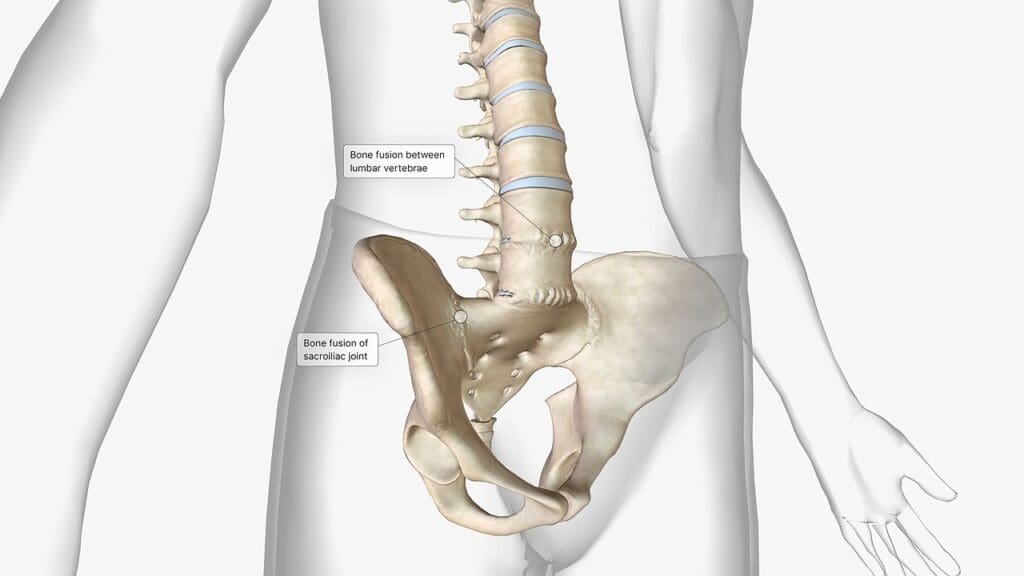 Bulging Versus Herniated