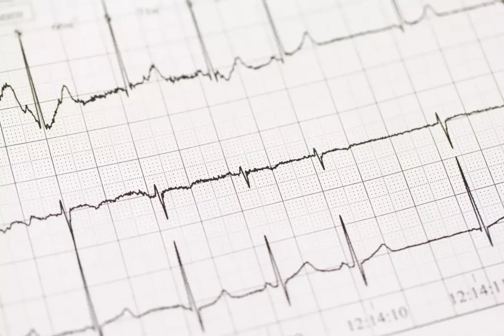 Defining Atrial Fibrillation and Atrial Flutter