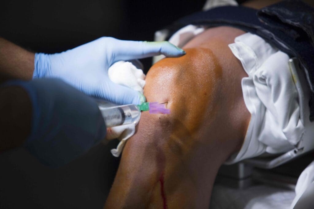 Detailed close-up of a human knee joint, with a doctor's hand administering a hydrogel injection into the affected area