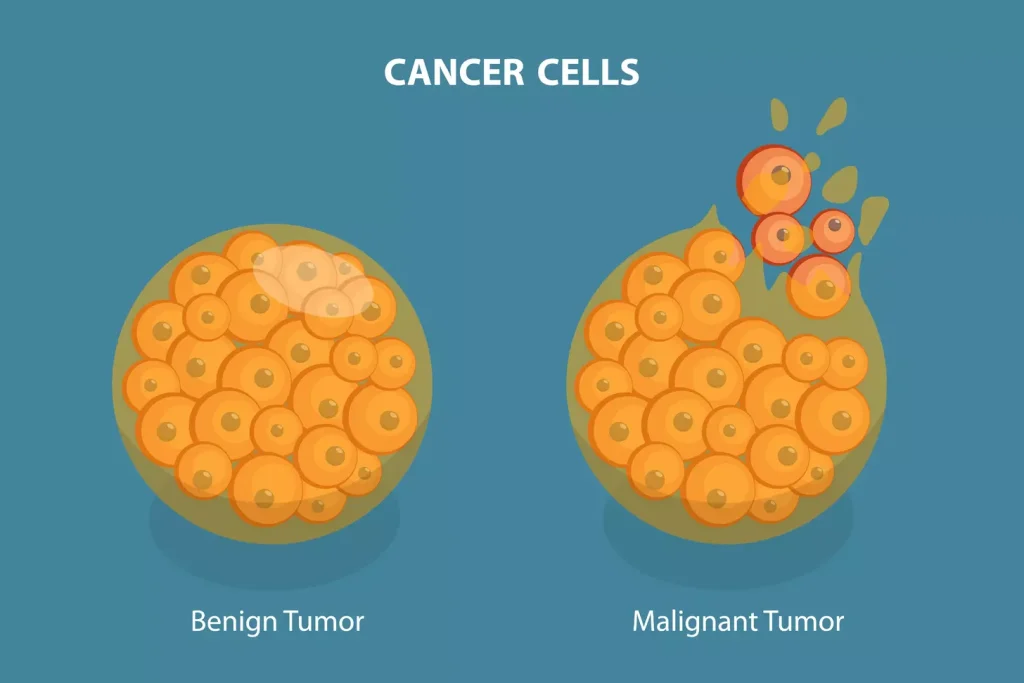 Differences between benign and malignant tumors