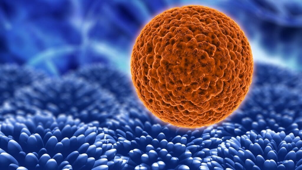 Diffuse Large B Cell Lymphoma Stage 4