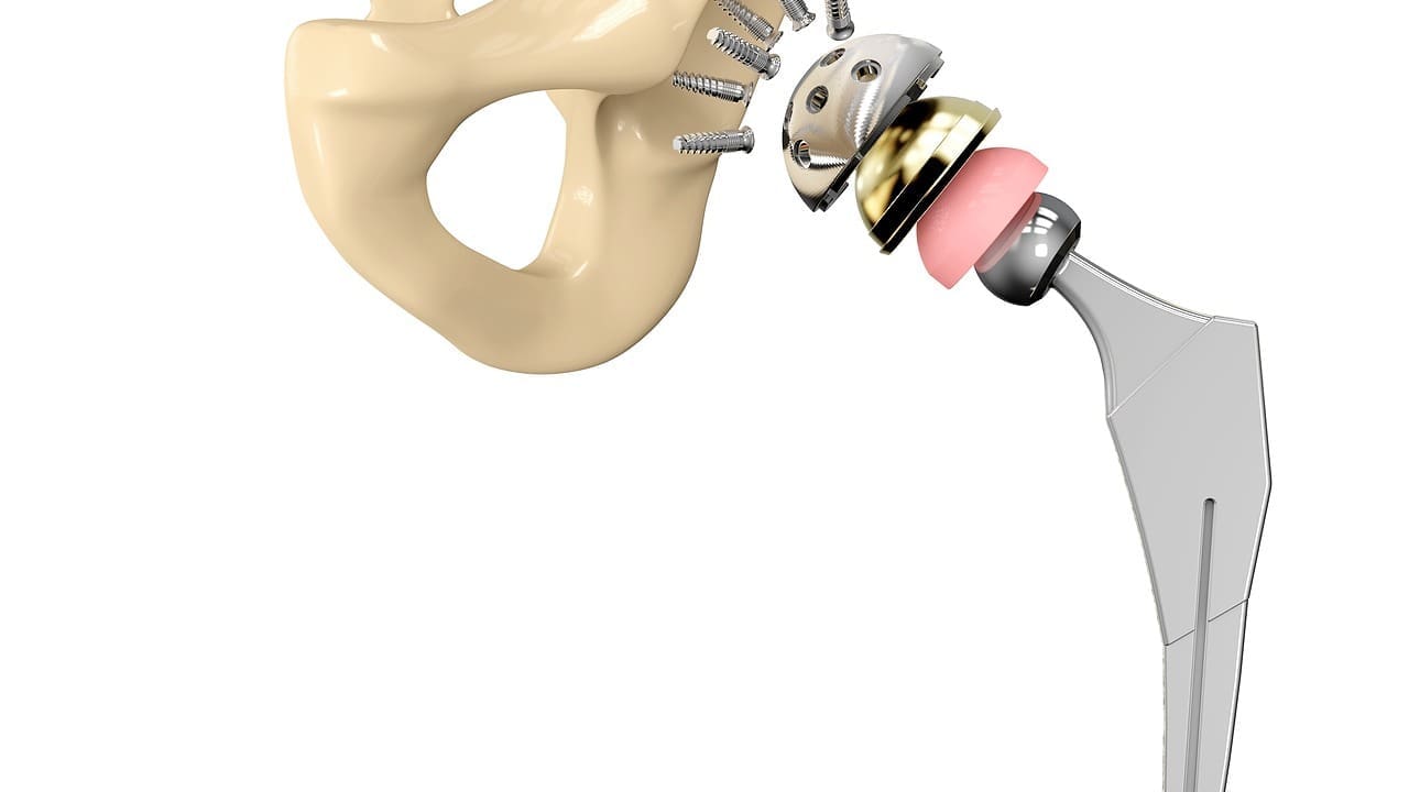 Hip Implant Parts