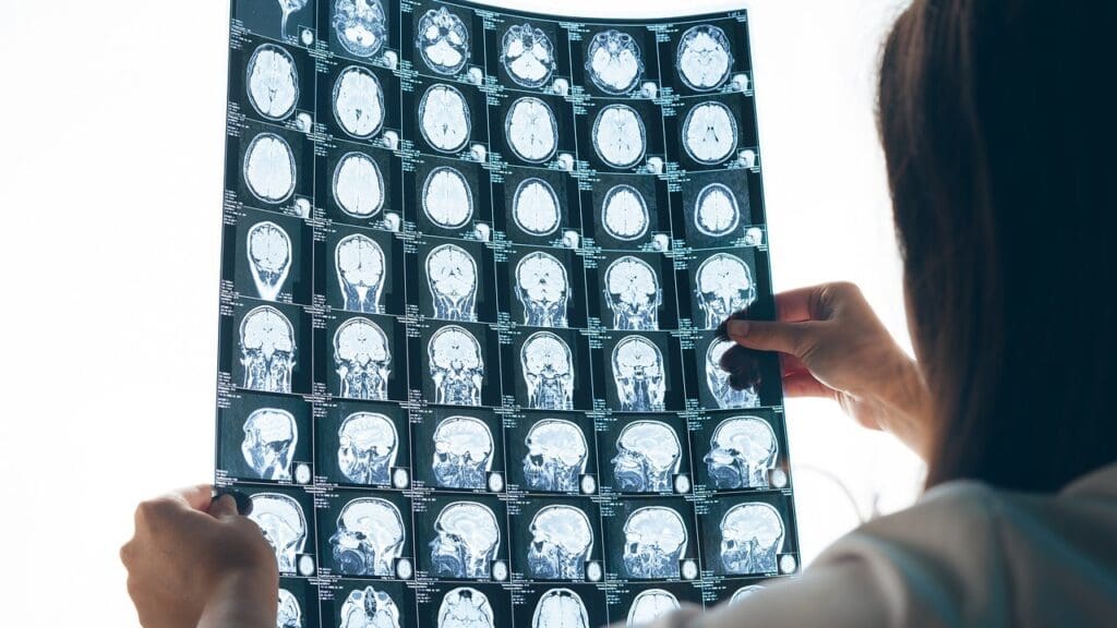 Importance of Early Detection in Brainstem Cancer