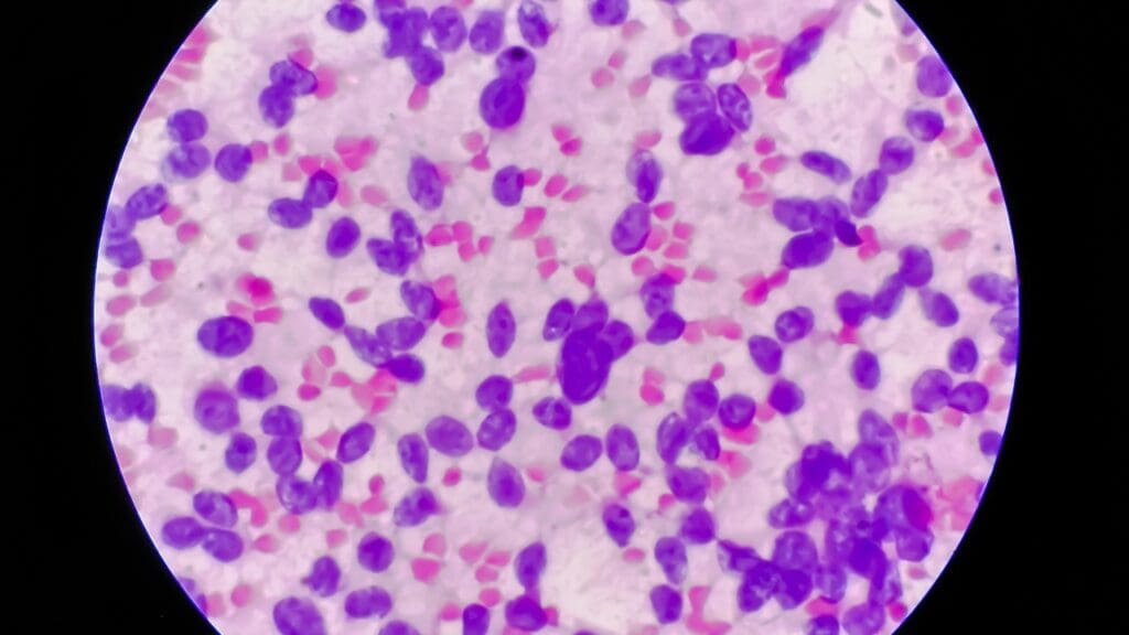 Large B-Cell Lymphoma