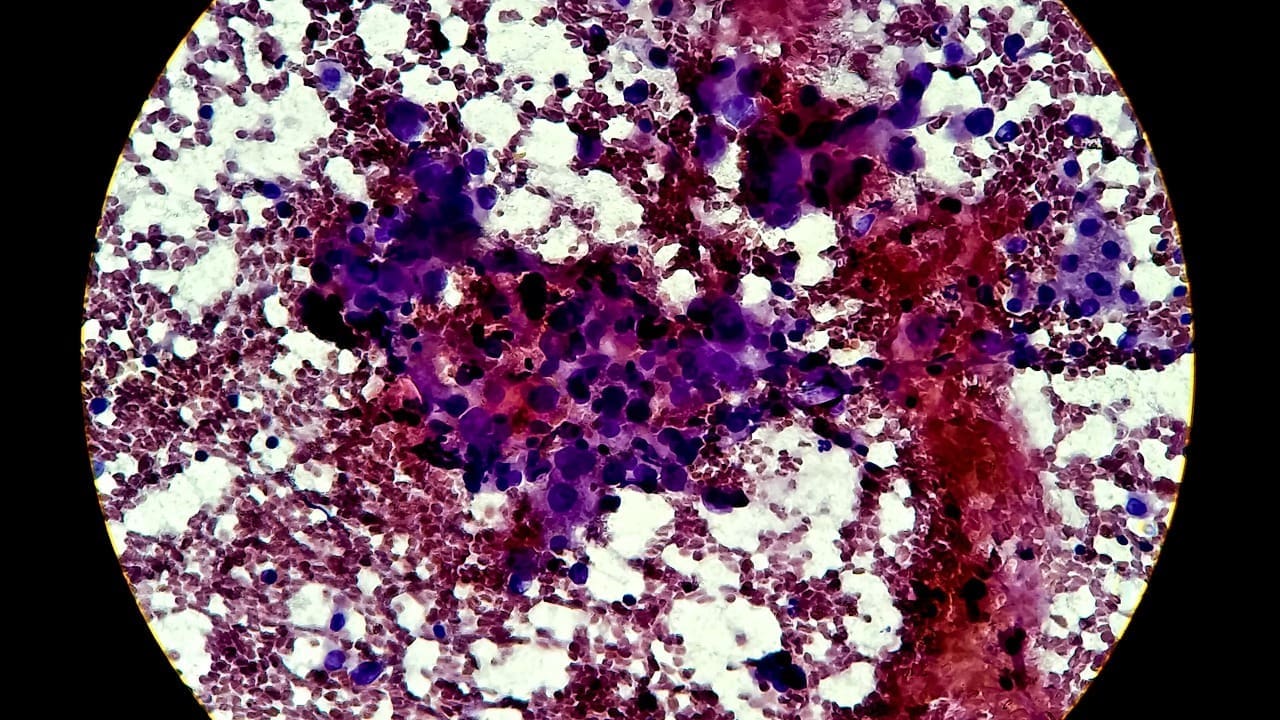 Large B-Cell Lymphoma (DLBCL)
