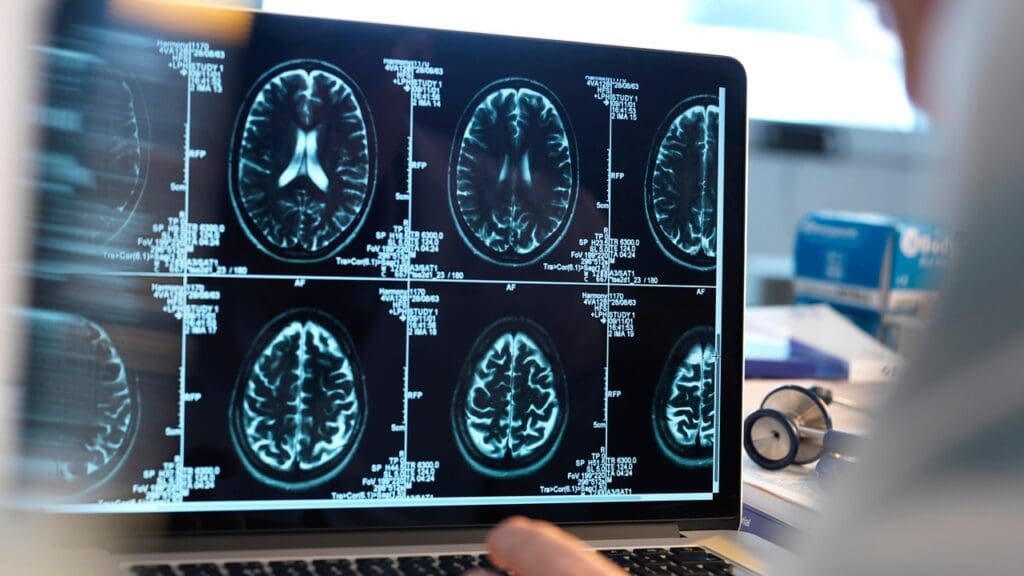 MRI brain damage detection