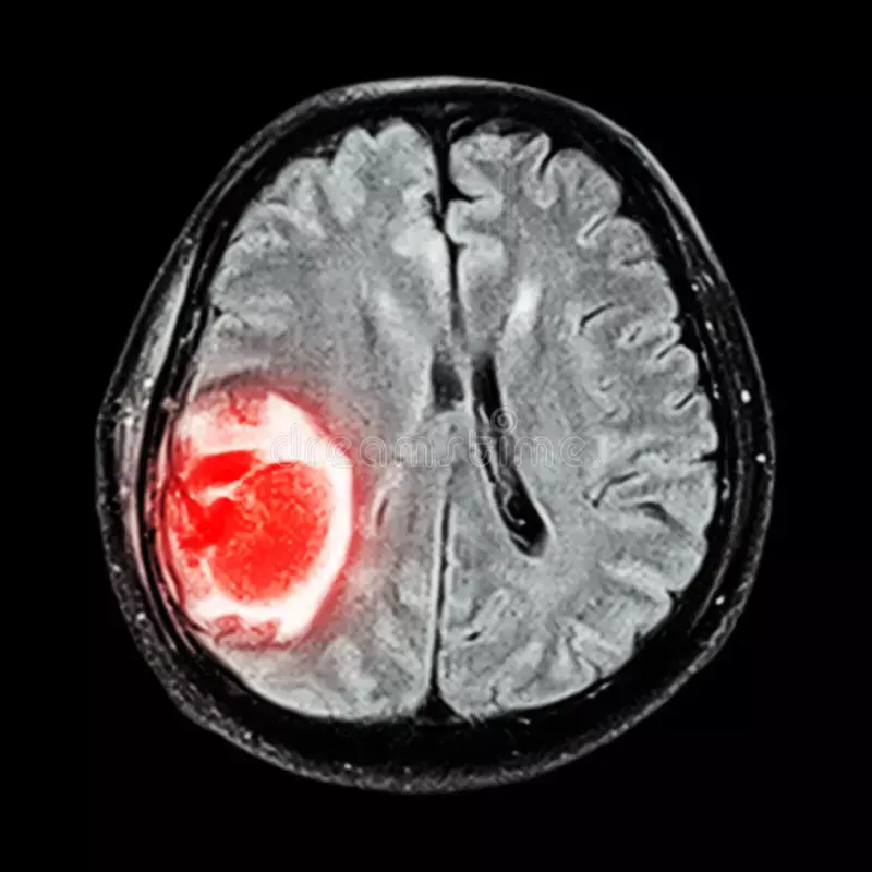 MRI brain tumor