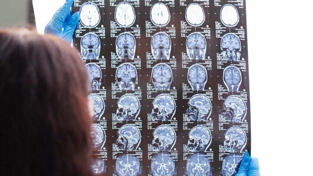 MRI vs CT Scan for Traumatic Brain Injury