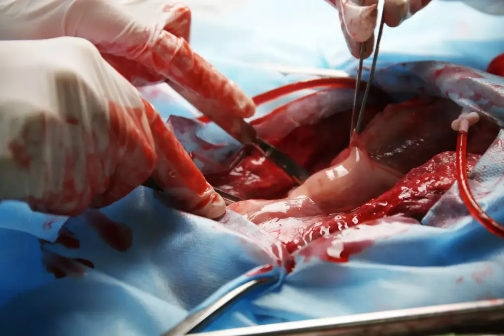 Mildly Dilated Aortic Root