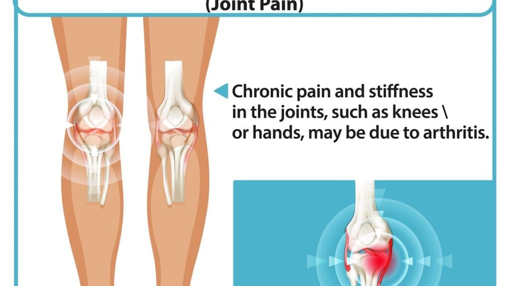 Patellofemoral Arthritis