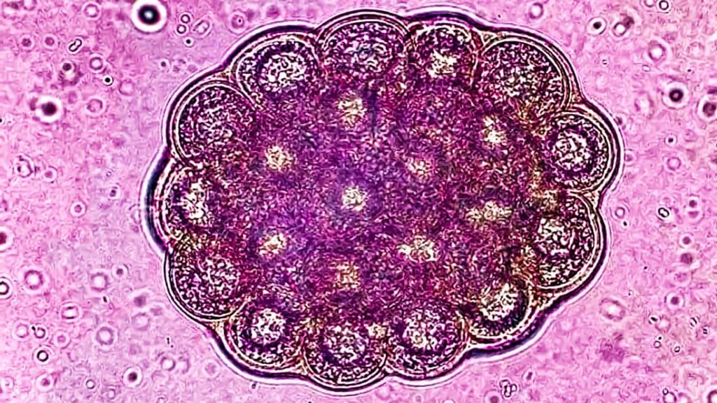 Stage 4 Diffuse Large B Cell Lymphoma