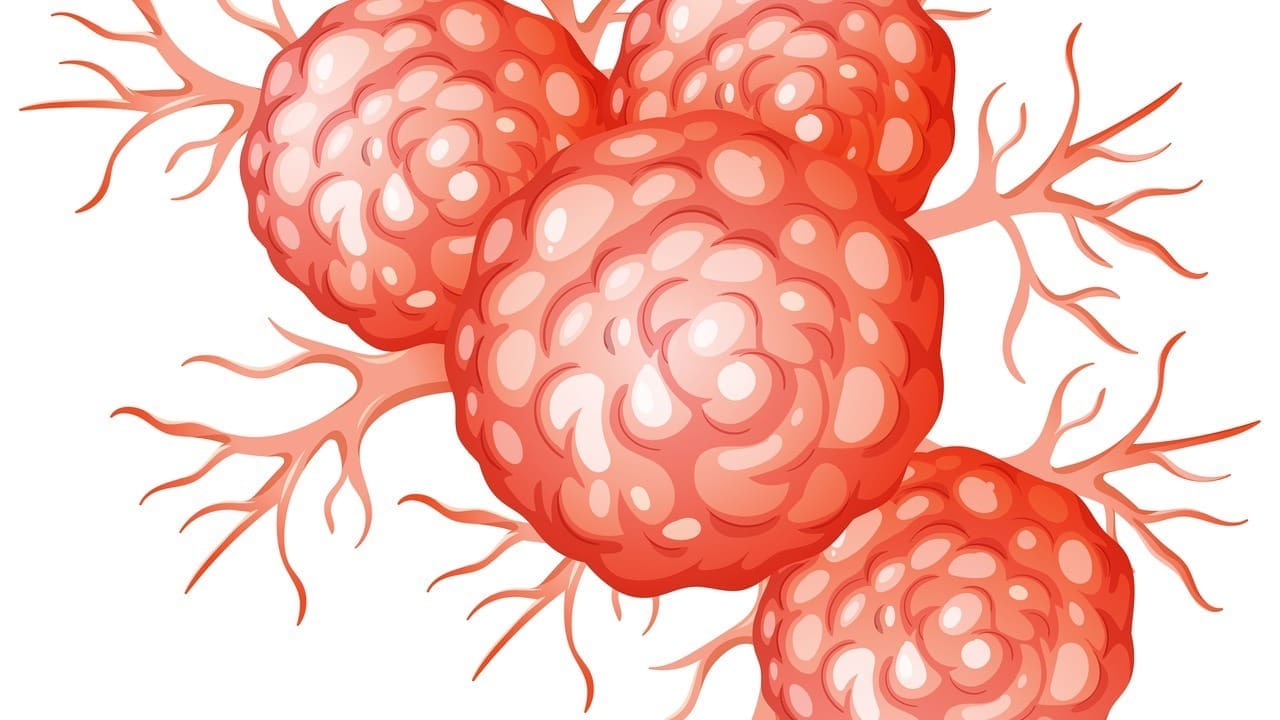 Stage 4 Diffuse Large B Cell Lymphoma