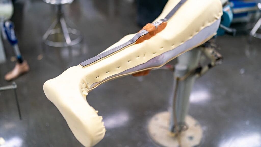 Total Knee Replacement Surgery