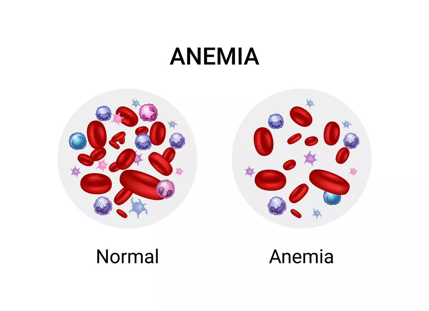Type of Anemia