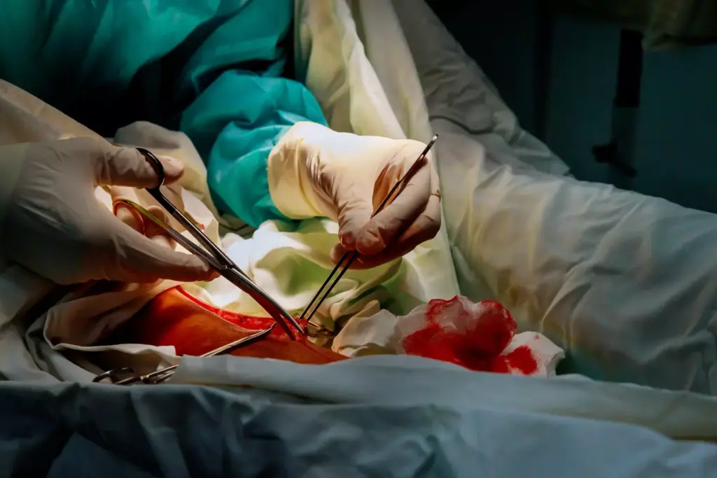 Understanding Abdominal Aortic Aneurysms (AAA)